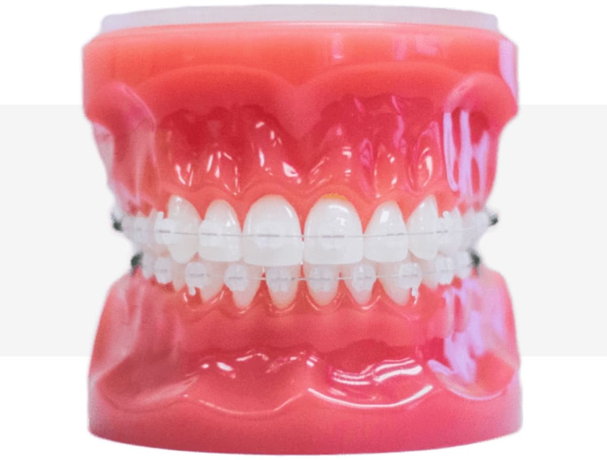 clear braces model